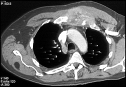 Tumor Destroys Sternum and Chest Wall- Also Rib Metastases - CTisus CT Scan