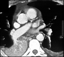 Mucus Plug in Bronchus Intermedius and Collapsed Right Lower Lobe - CTisus CT Scan