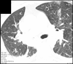 Collapsed Right Lower Lobe - CTisus CT Scan