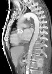 Ductus Aneurysm - CTisus CT Scan