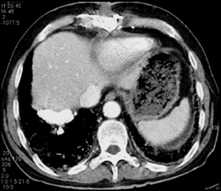 Asbestosis - CTisus CT Scan