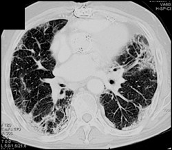 Asbestosis With Fibrosis - CTisus CT Scan