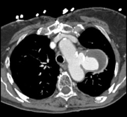 Ductus Aneurysm - CTisus CT Scan