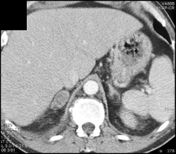 Adrenal Metastases From Lung Cancer - CTisus CT Scan