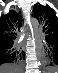 Aspiration Into Right Mainstem Bronchus - CTisus CT Scan