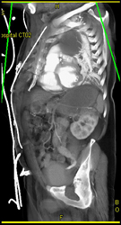 Aortic Pseudoaneurysm - CTisus CT Scan