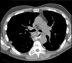 Perforated Esophagus and Posterior Mediastinal Abscess - CTisus CT Scan