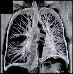 3D on the Left Mainstem Bronchus Which Is Narrowed - CTisus CT Scan