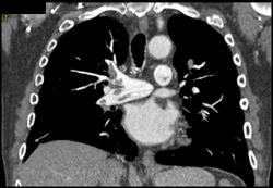 Pulmonary Embolism - CTisus CT Scan