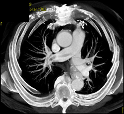 Pulmonary Embolism - CTisus CT Scan