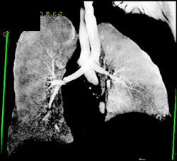 Virtual Bronchoscopy With Stenosis of Left Mainstem Branches - CTisus CT Scan