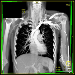 Ct Angiogram of the Mediastinum and Axilla - CTisus CT Scan