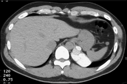 High Density Sequestration on Left - CTisus CT Scan