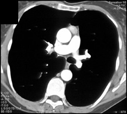 Thymoma - CTisus CT Scan