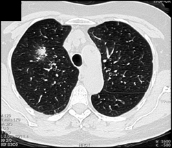 Aspergillosis in Angiomyolipoma (AML) Patient - CTisus CT Scan