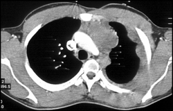 Thymoma - CTisus CT Scan