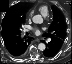 Pulmonary Embolism - CTisus CT Scan