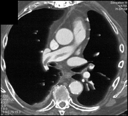 Pulmonary Embolism - CTisus CT Scan