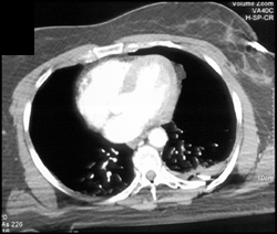 Pneumothorax and Rib Fractures S/P MVA - CTisus CT Scan