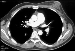 Breast Abscess in Male - CTisus CT Scan