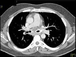 Tumor Encases the Tracheal Bifurcation - CTisus CT Scan