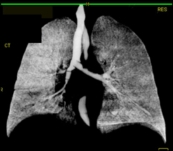 Encased and Invaded Left Mainstem Bronchus - CTisus CT Scan