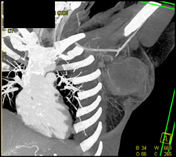 Sarcoma in Left Axilla - CTisus CT Scan