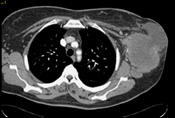 Sarcoma - CTisus CT Scan