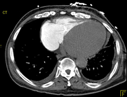 Contrast in Right Side of the Heart - CTisus CT Scan