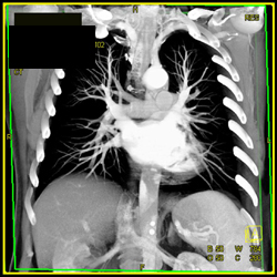 3D of the Pulmonary Veins - CTisus CT Scan