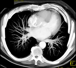 Pulmonary Veins - CTisus CT Scan