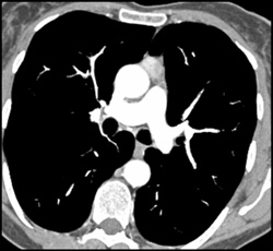 Thymoma - CTisus CT Scan