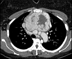 Substernal Thyroid - CTisus CT Scan