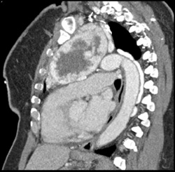 Substernal Thyroid - CTisus CT Scan