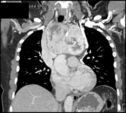 Substernal Thyroid - CTisus CT Scan