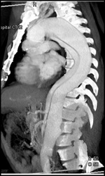 Type B Dissection - CTisus CT Scan