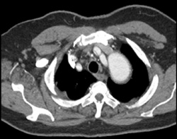 Type B Dissection Into Arch Vessels - CTisus CT Scan