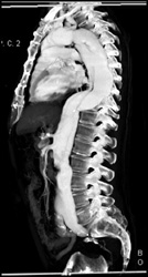 Type B Dissection Extends to Celiac Artery - CTisus CT Scan