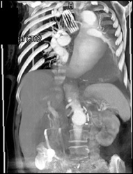 Large Descending Aorta Aneurysm - CTisus CT Scan