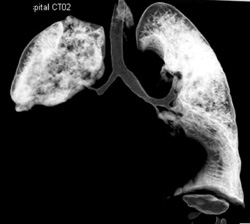 Tumor Encases Major Bronchi - CTisus CT Scan