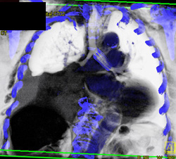 Tumor Encases Both Major Bronchi - CTisus CT Scan