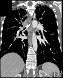 Stent in Right Mainstem Bronchus. Lung Cancer Encases Right Mainstem and Trachea - CTisus CT Scan