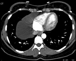 Pericardial Cyst - CTisus CT Scan