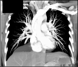 Pericardial Cyst - CTisus CT Scan