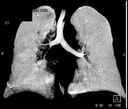 Encased Right Mainstem Bronchus - CTisus CT Scan