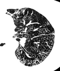 Interstitial Infiltrate - CTisus CT Scan