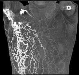 Occluded SVC With Collaterals - CTisus CT Scan