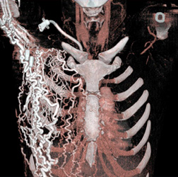 Extensive Chest Wall Collaterals - CTisus CT Scan