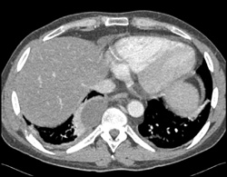 Subcrural Abscess - CTisus CT Scan