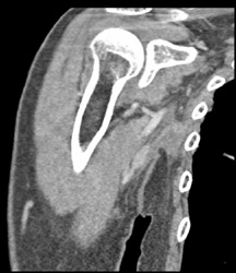 Axillary Nodes - CTisus CT Scan